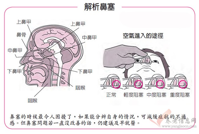 長(zhǎng)期鼻塞，需區(qū)分鼻炎與鼻咽癌的差別，不可小覷！