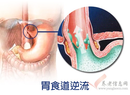 胃食道逆流患注意進食順序