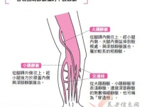 關(guān)于靜脈曲張類型的區(qū)分