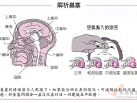 長期鼻塞，需區(qū)分鼻炎與鼻咽癌的差別，不可小覷！